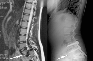 Illustration d'un spondylolisthésis vertébral