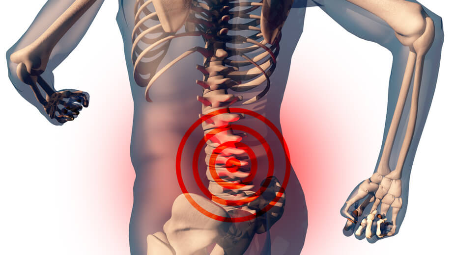 Illustration d'une sténose du canal lombaire